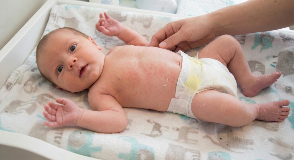 normal recien nacido descamacion