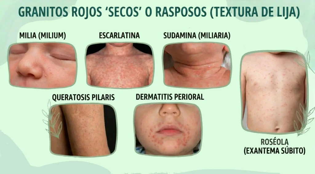 Los granitos rojos secos o rasposos afloran al padecer milia, escarlatina, sudamina, queratosis pilaris o dermatitis perioral